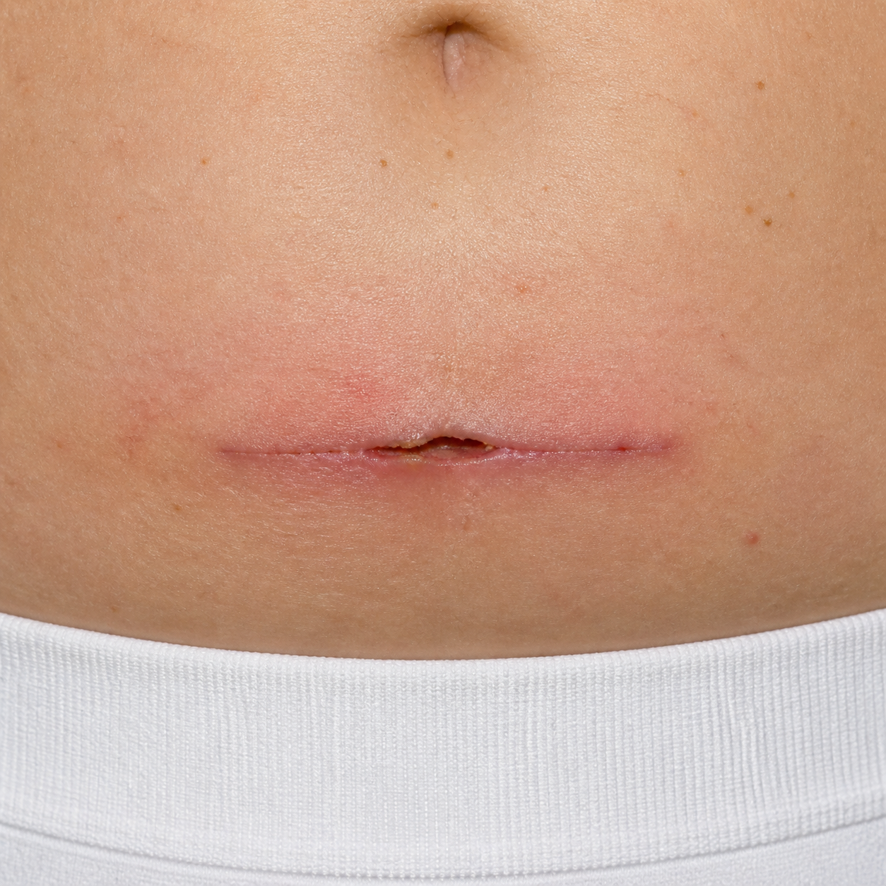 Clinical image representing surgical wound care